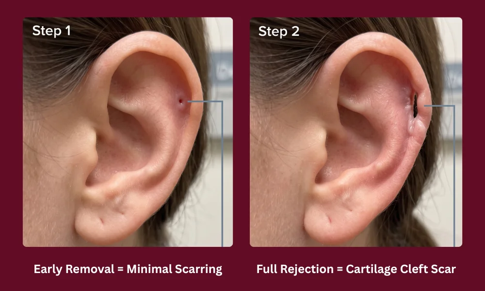 Piercing Rejection Scar: What to Expect and How to Minimize It