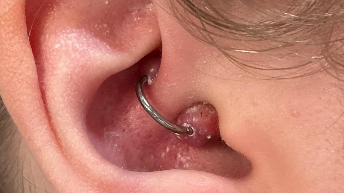 Daith Piercing Bump: Why It Happens and Proven Ways to Heal Fast